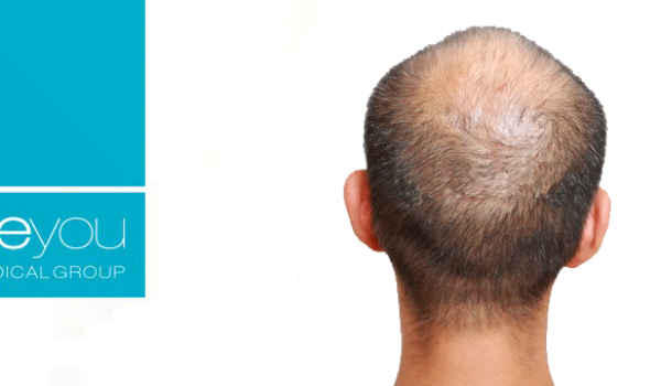 alopecia-avanzada-beyou