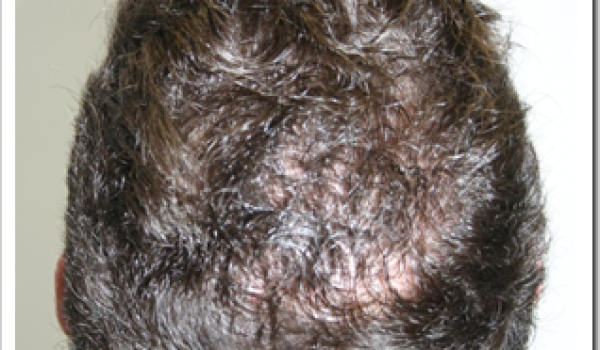alopecia_2.png