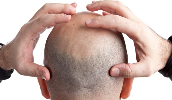 Combate la alopecia con una reducción del área calva