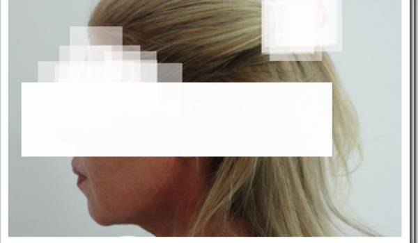 Cervicoplastia-post.png