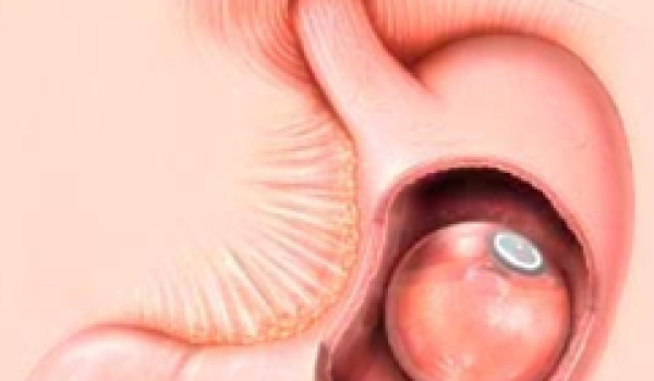 colocacion-balon-intragastrico.png