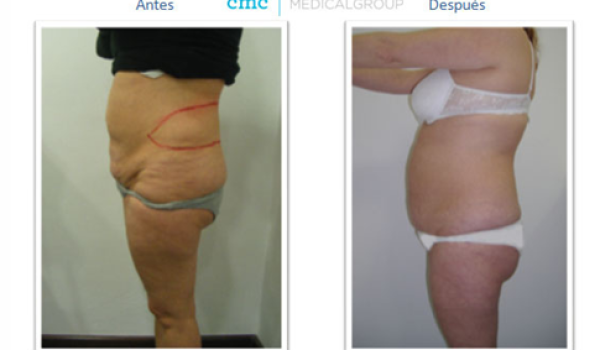 liposuccion-operacion.png