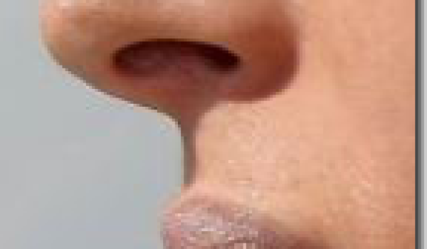 rinoplastia-septoplastia.png