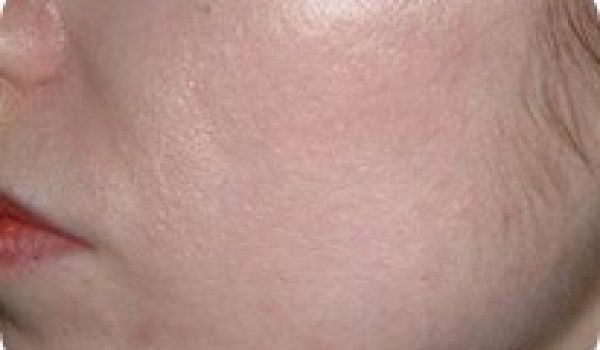 tratamiento-facial-laser-fraxel.jpg